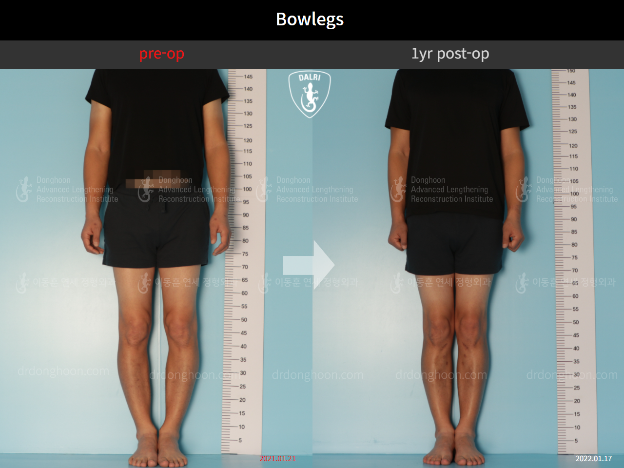 Before and after adult bowlegs, case 9487634, image 1, Dr. Donghoon institute (DALRI)