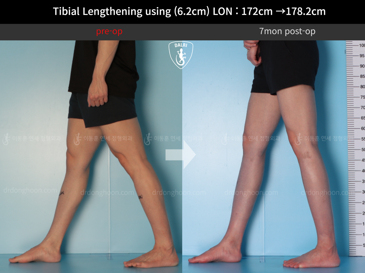 Before and after cll lon, case 12519142, image 7, Dr. Donghoon institute (DALRI)