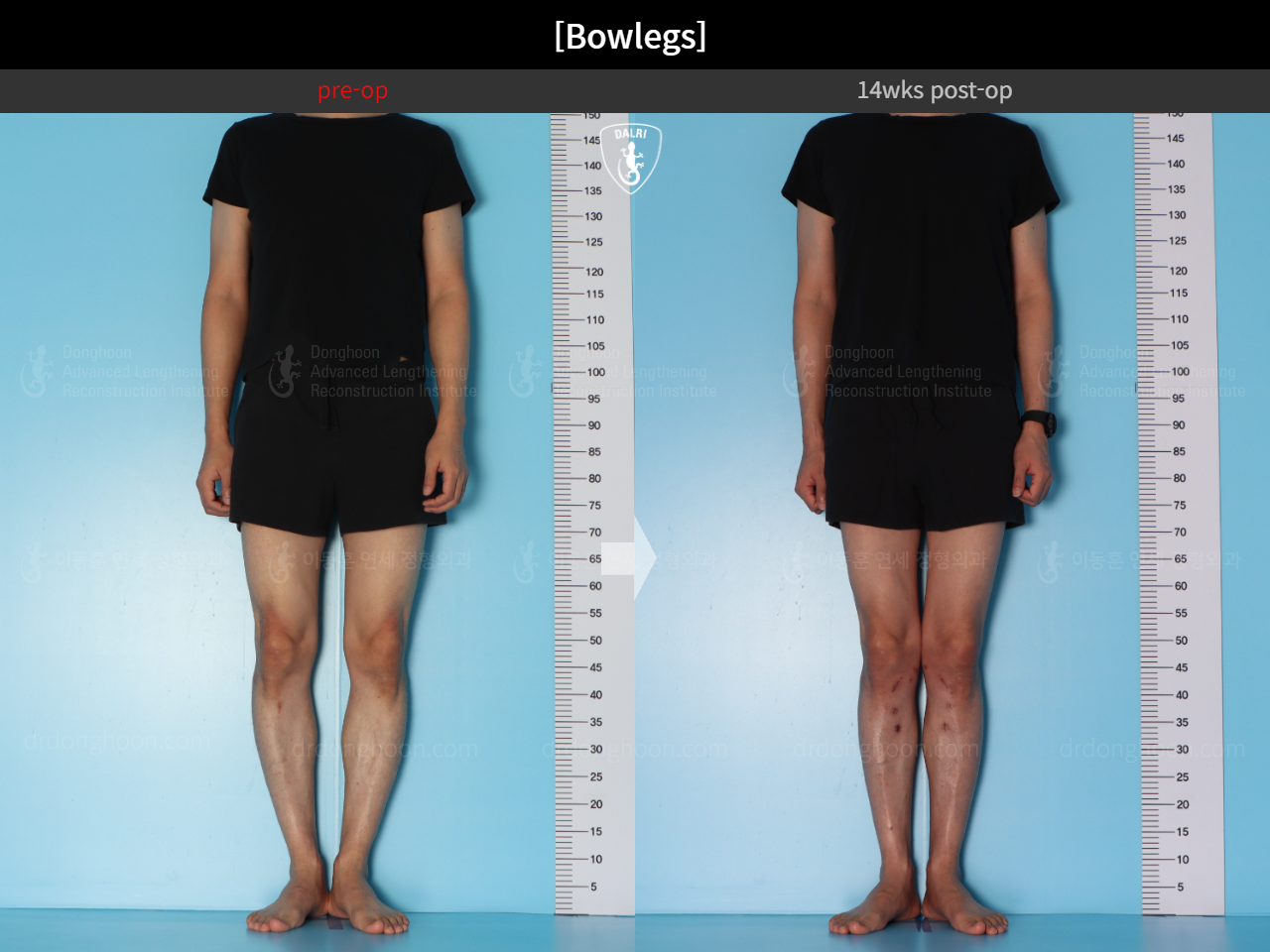 Before and after adult bowlegs, case 15512423, image 2, Dr. Donghoon institute (DALRI)
