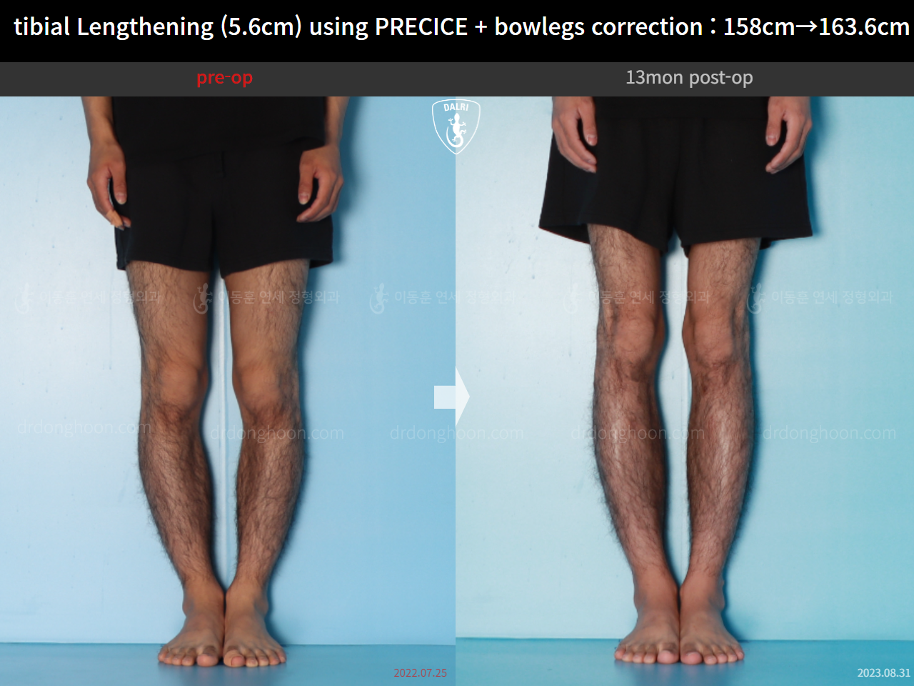 Before and after cll precice, case 16213622, image 7, Dr. Donghoon institute (DALRI)