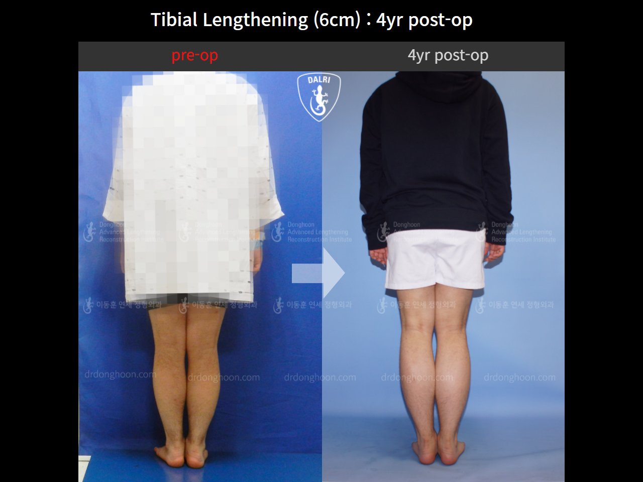 Before and after cll lon, case 10474212, image 2, Dr. Donghoon institute (DALRI)