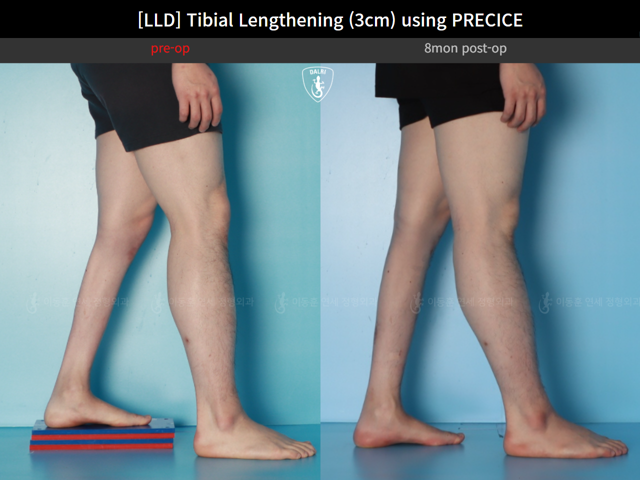 Before and after adult lld, case 124813877, image 8, Dr. Donghoon institute (DALRI)