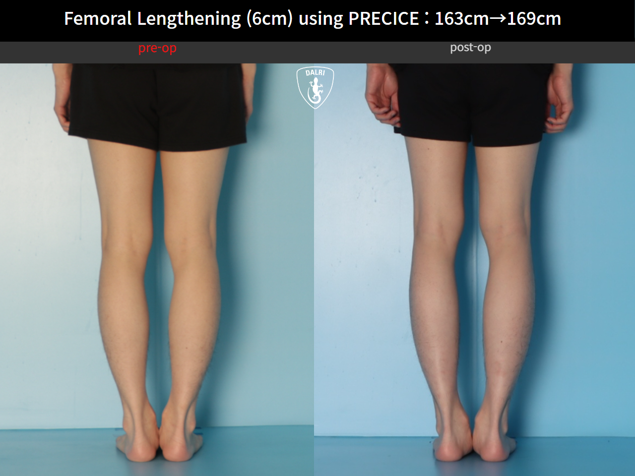 Before and after cll precice, case 33545760, image 6, Dr. Donghoon institute (DALRI)
