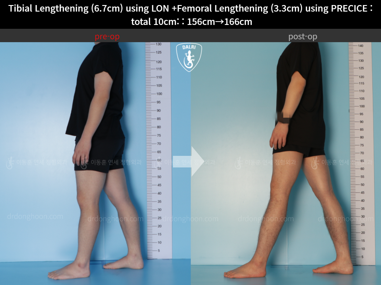 Before and after cll lon, case 11044268, image 4, Dr. Donghoon institute (DALRI)