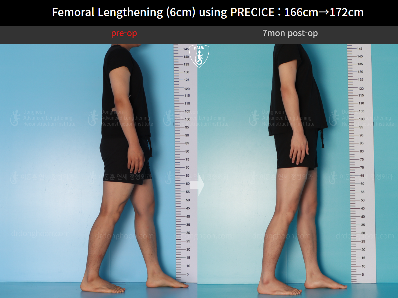 Before and after cll precice, case 17579263, image 4, Dr. Donghoon institute (DALRI)