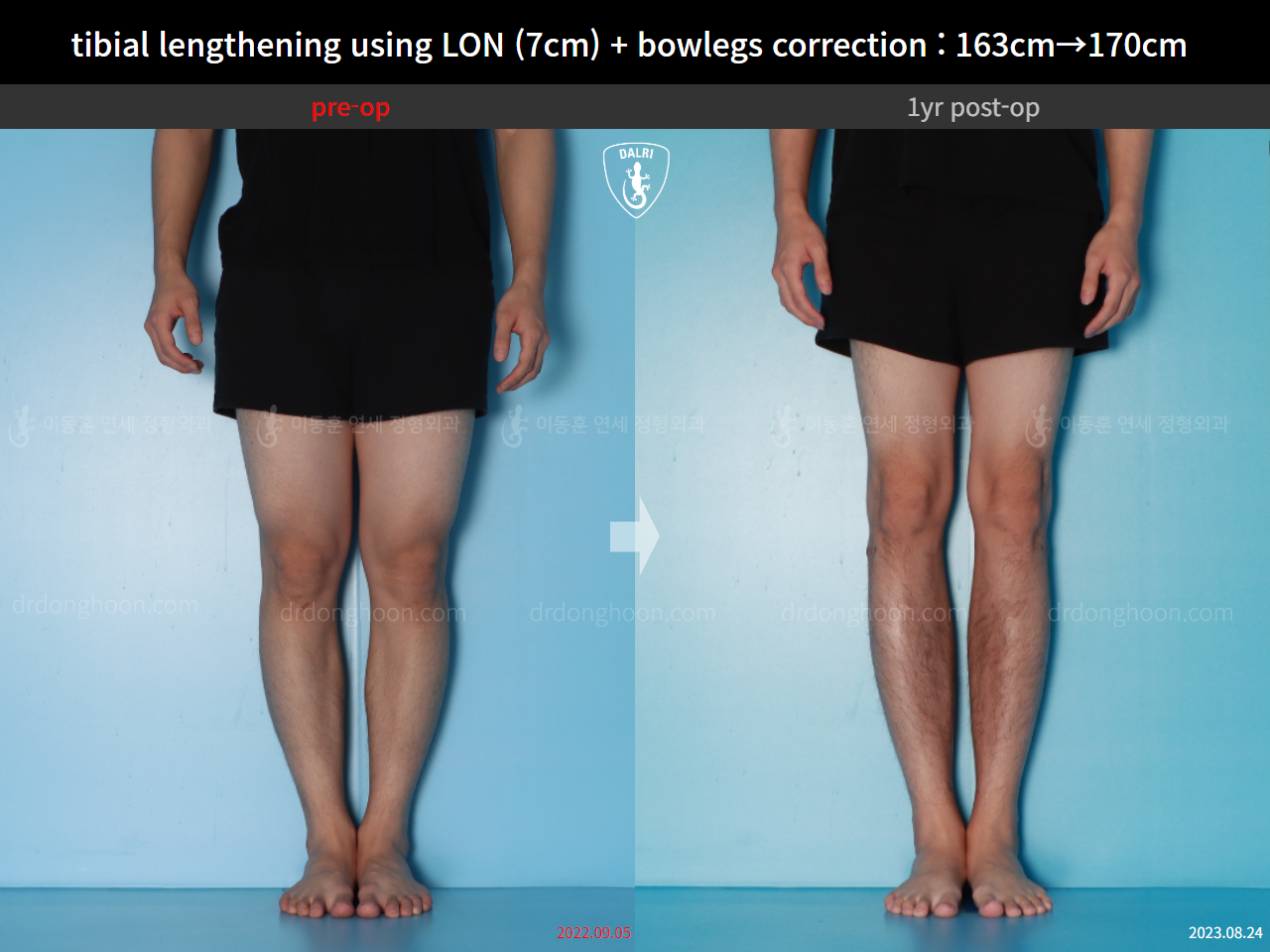 Before and after cll lon, case 16131902, image 9, Dr. Donghoon institute (DALRI)