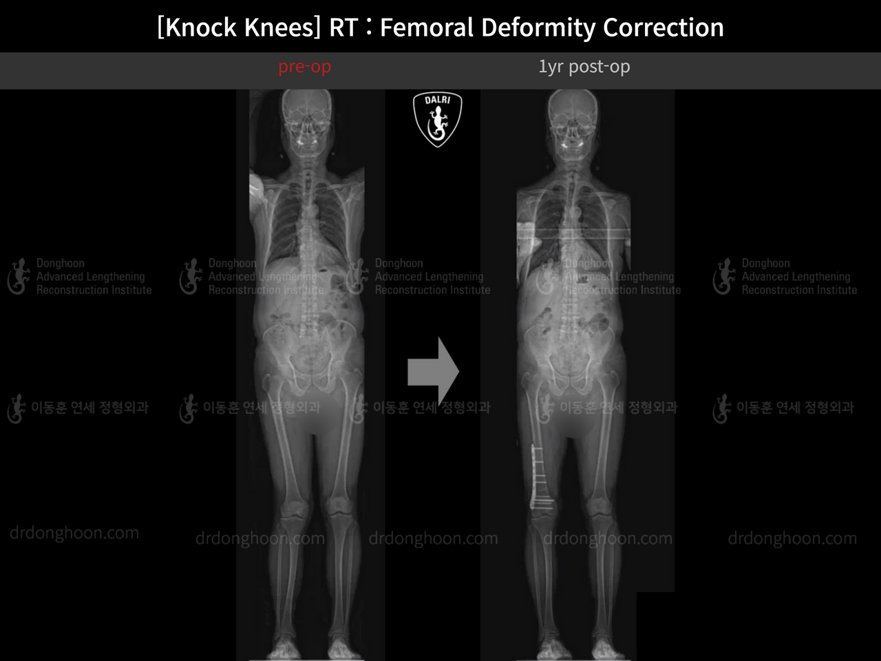 Before and after adult knock knees, case 14236357, image 11, Dr. Donghoon institute (DALRI)