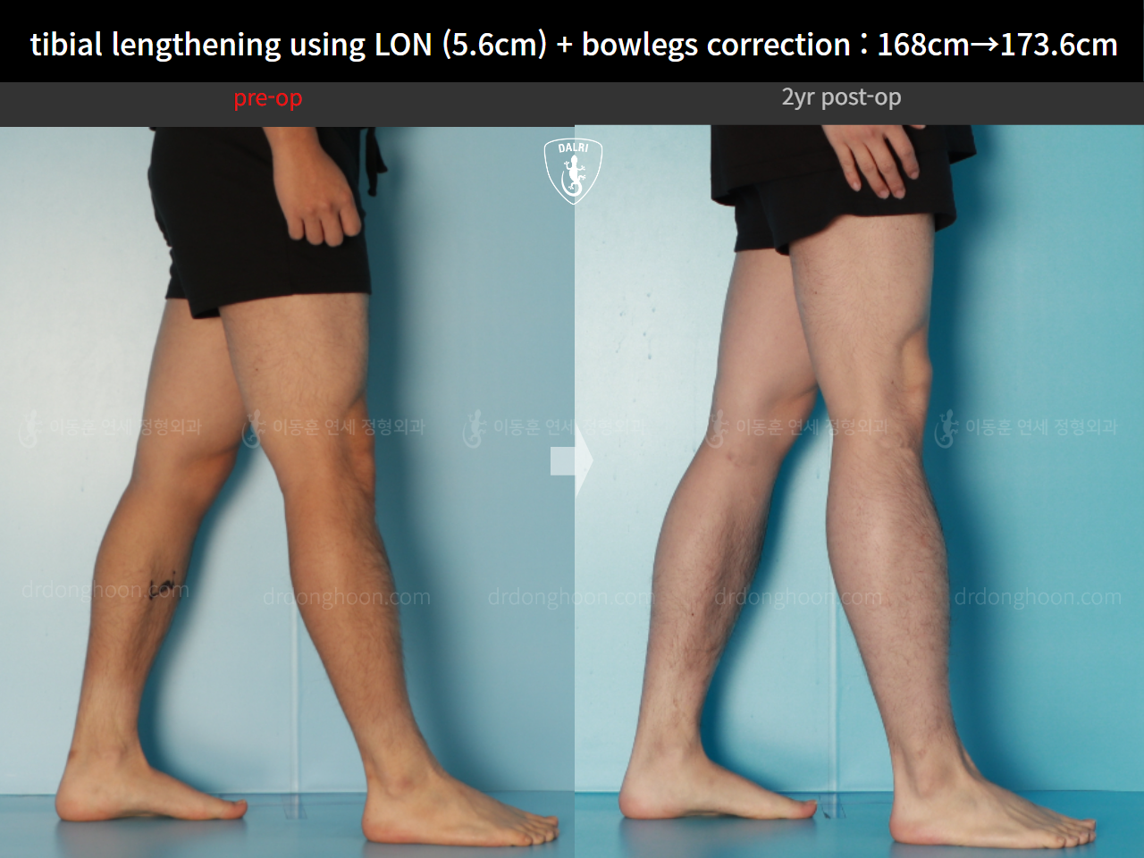 Before and after cll + deformity correction, case 17361975, image 7, Dr. Donghoon institute (DALRI)