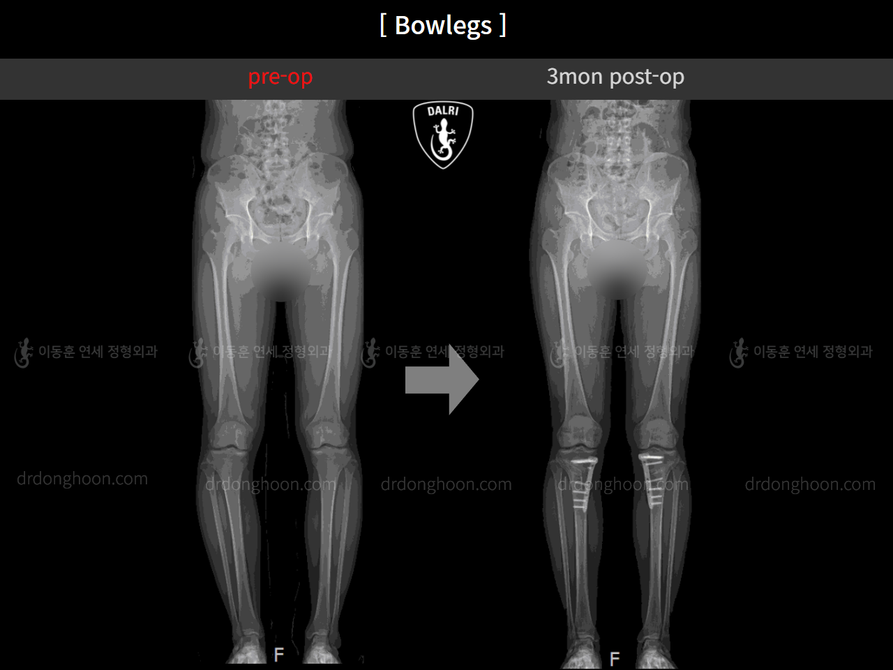 Before and after adult bowlegs, case 4311053, image 8, Dr. Donghoon institute (DALRI)