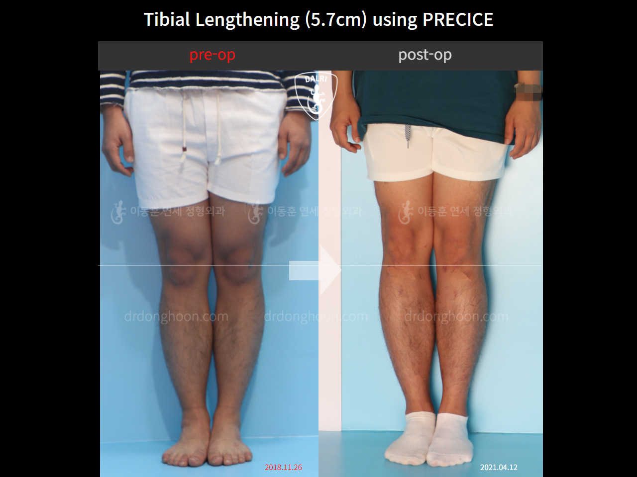Before and after cll precice, case 4323384, image 3, Dr. Donghoon institute (DALRI)
