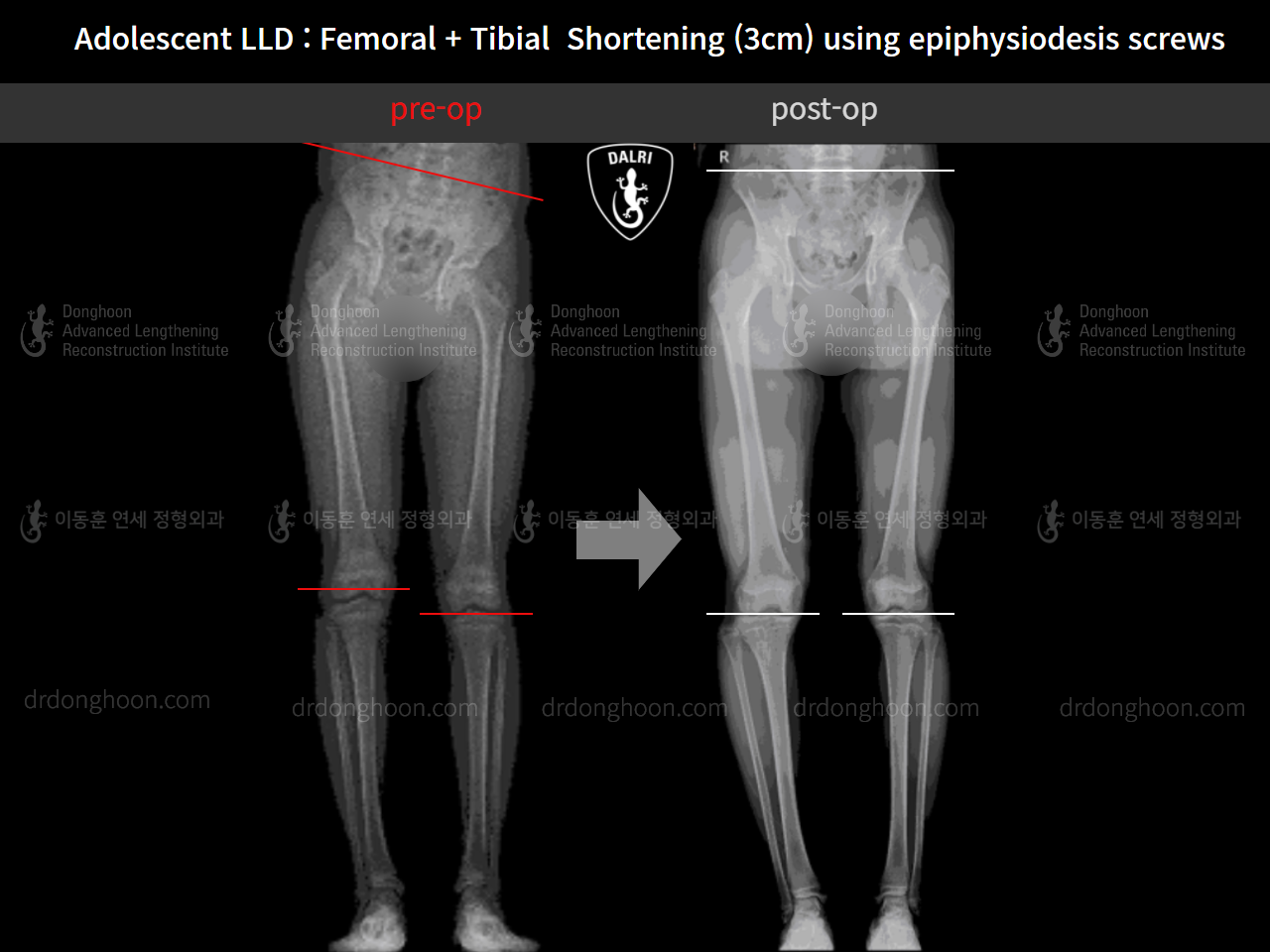 Before and after paediatric & adolescent lld, case 11511257, image 8, Dr. Donghoon institute (DALRI)