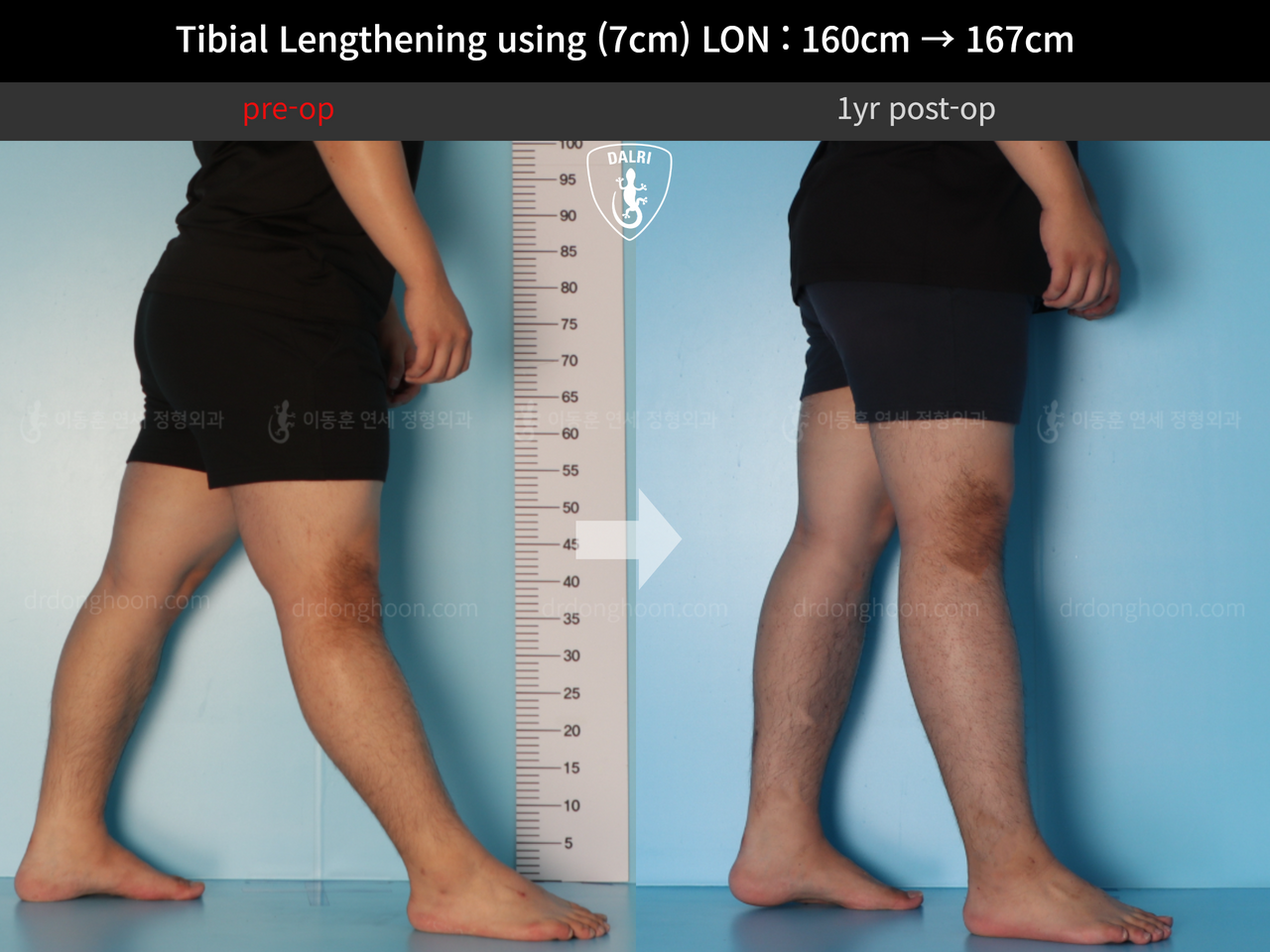 Before and after cll lon, case 12395704, image 7, Dr. Donghoon institute (DALRI)