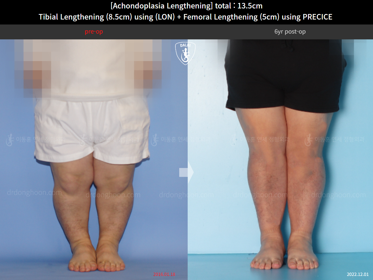 Before and after cll lon, case 14993527, image 9, Dr. Donghoon institute (DALRI)