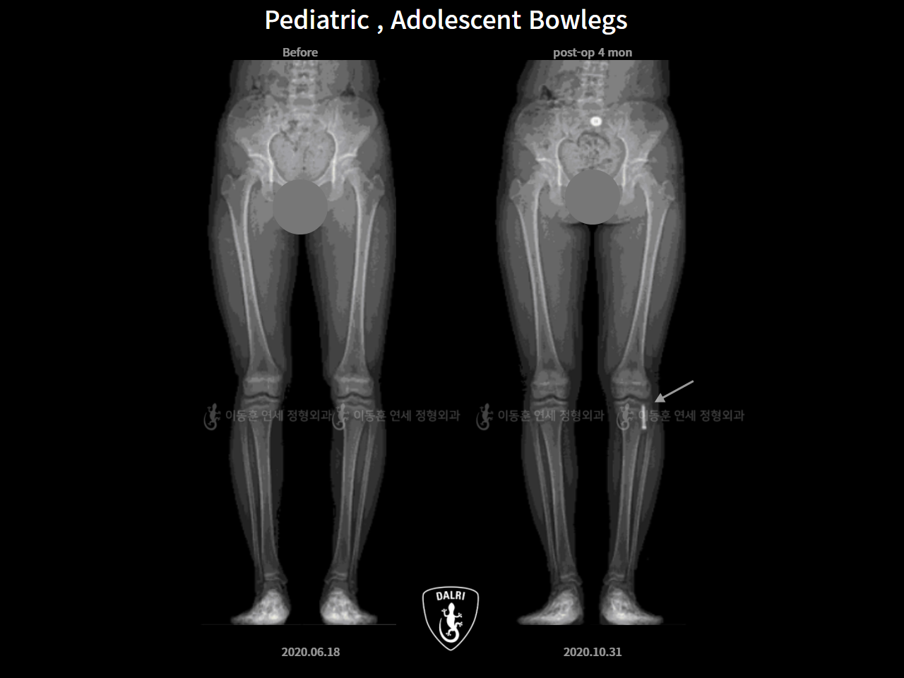 Before and after paediatric & adolescent bowlegs, case 6638717, image 1, Dr. Donghoon institute (DALRI)