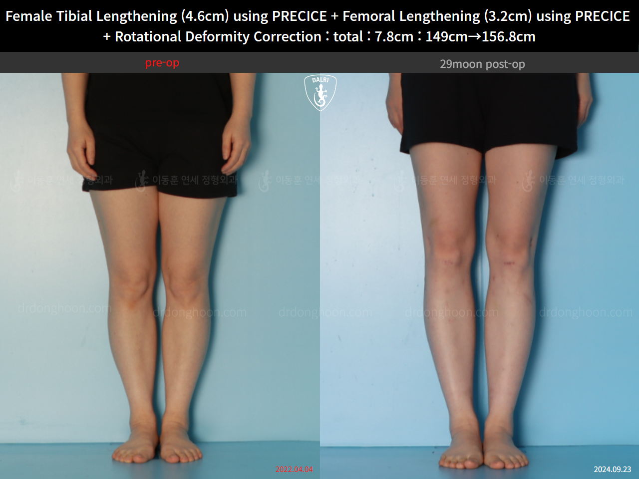 Before and after cll precice, case 123686647, image 9, Dr. Donghoon institute (DALRI)