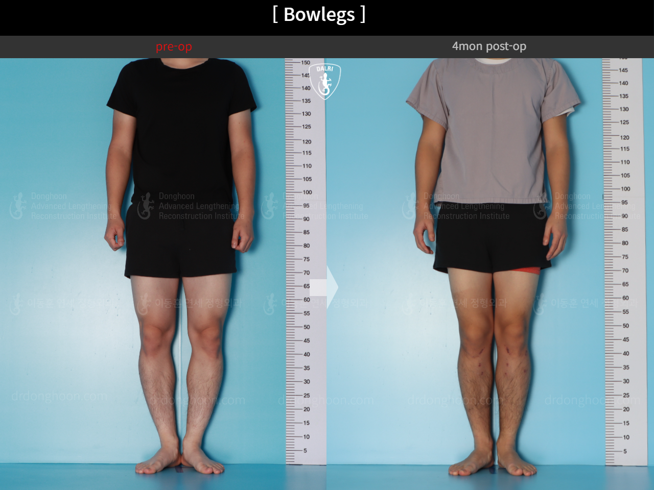 Before and after adult bowlegs, case 18479637, image 2, Dr. Donghoon institute (DALRI)