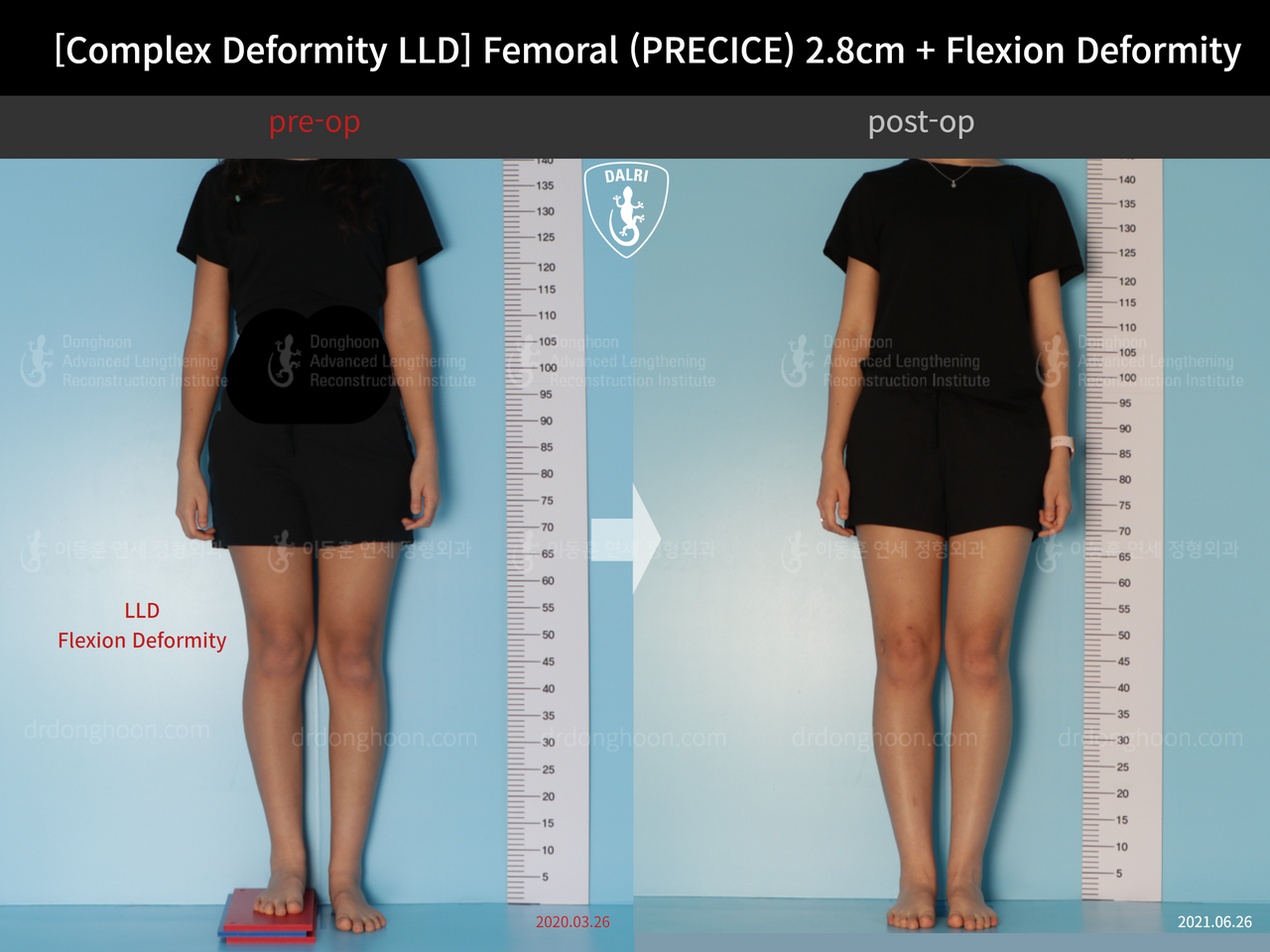 Before and after adult lld, case 13168213, image 1, Dr. Donghoon institute (DALRI)
