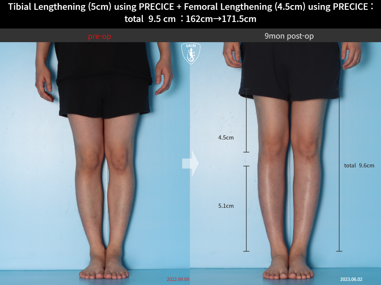 Before and after cll precice, case 15344460, image 9, Dr. Donghoon institute (DALRI)