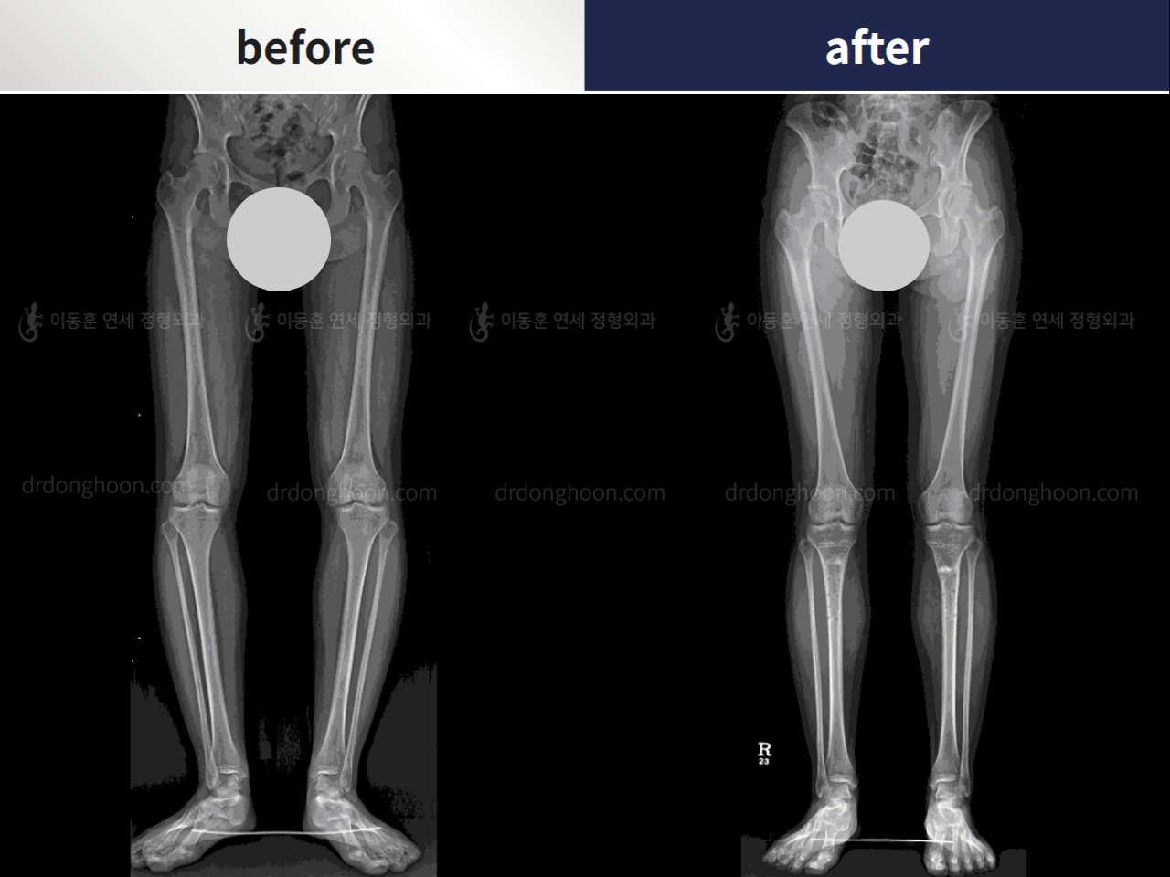 Before and after complex deformity, case 4251615, image 3, Dr. Donghoon institute (DALRI)