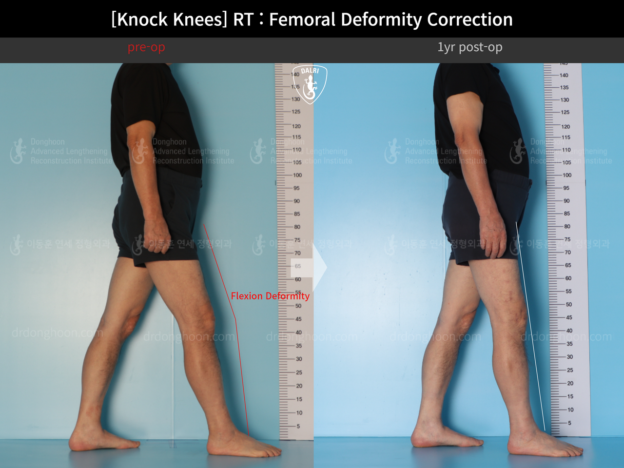 Before and after adult knock knees, case 14236357, image 3, Dr. Donghoon institute (DALRI)