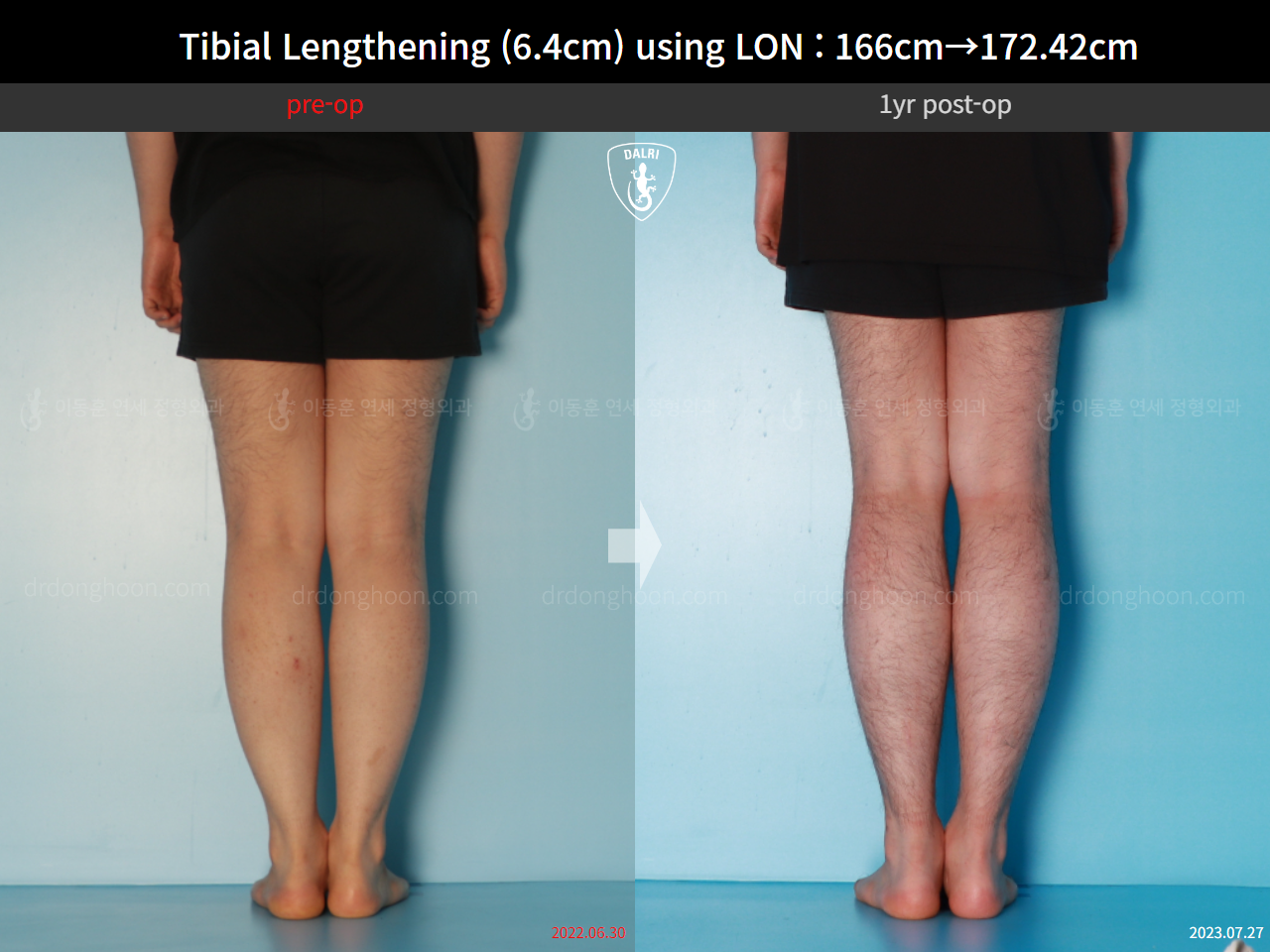 Before and after cll lon, case 15889727, image 7, Dr. Donghoon institute (DALRI)