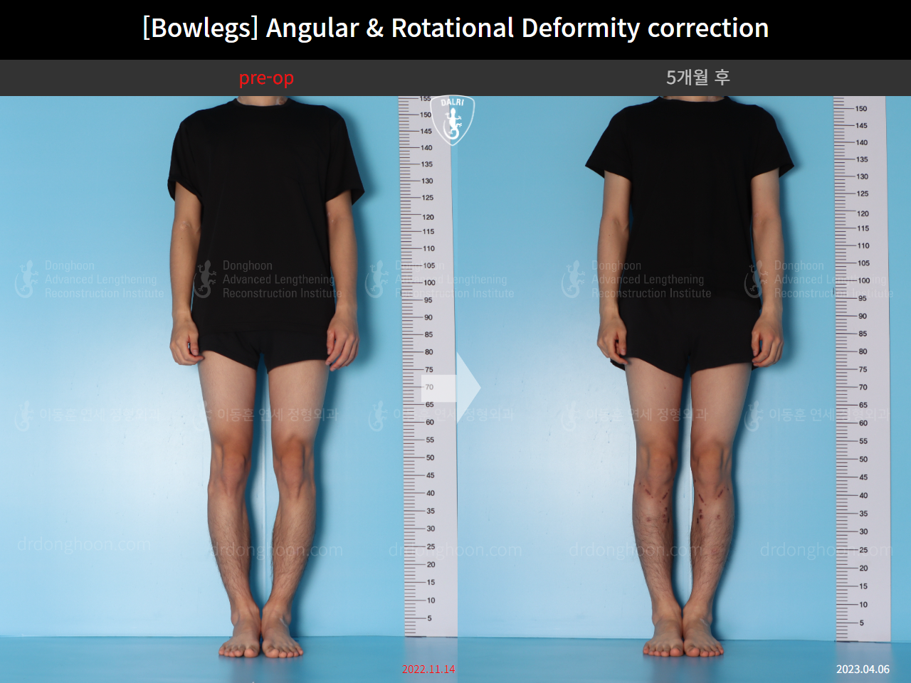 Before and after adult bowlegs, case 14707617, image 1, Dr. Donghoon institute (DALRI)