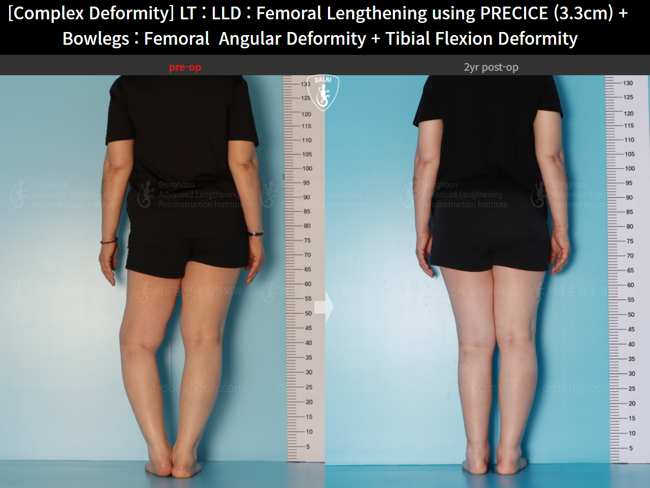 Before and after complex deformity, case 16786707, image 7, Dr. Donghoon institute (DALRI)