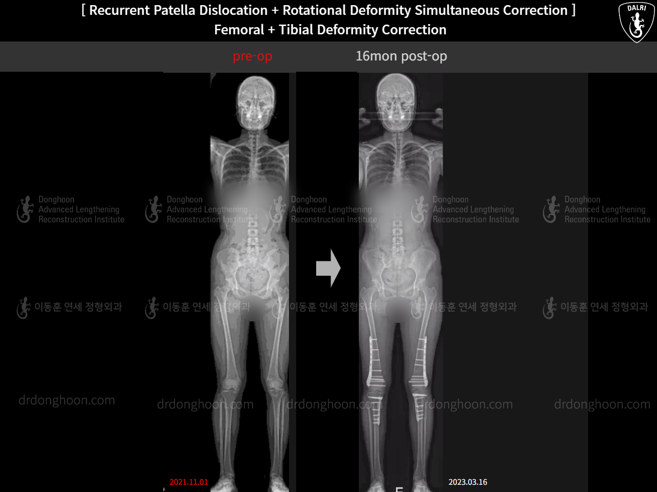 Before and after adult bowlegs, case 15131364, image 5, Dr. Donghoon institute (DALRI)