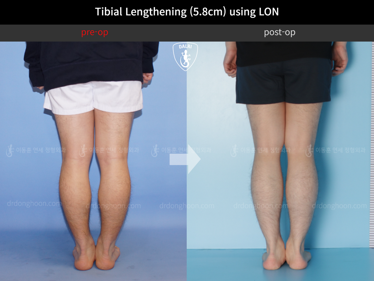 Before and after cll lon, case 4577732, image 6, Dr. Donghoon institute (DALRI)