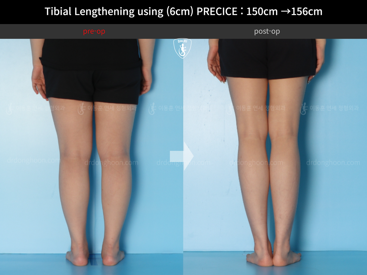 Before and after cll precice, case 14065180, image 6, Dr. Donghoon institute (DALRI)