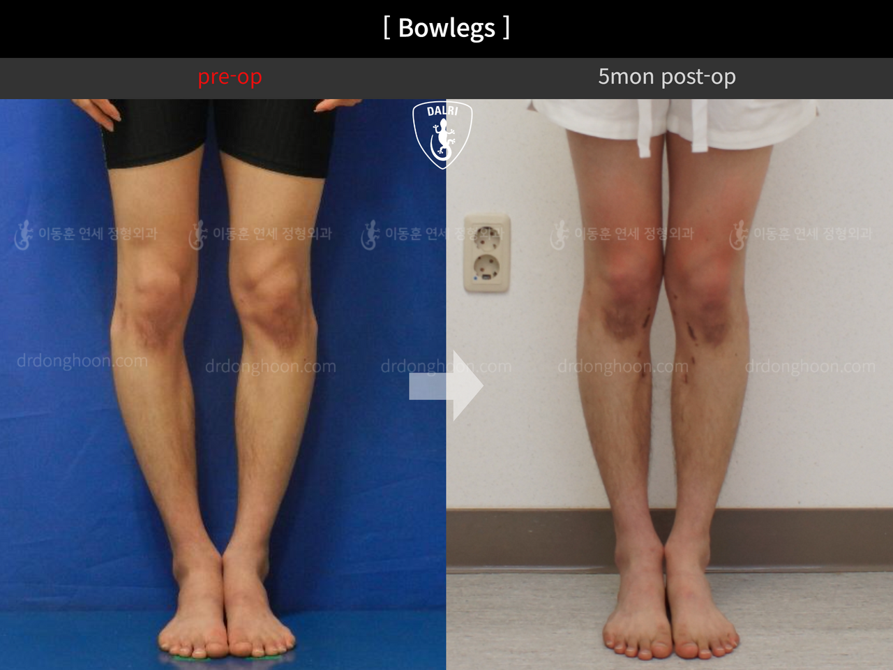 Before and after adult bowlegs, case 12756537, image 4, Dr. Donghoon institute (DALRI)