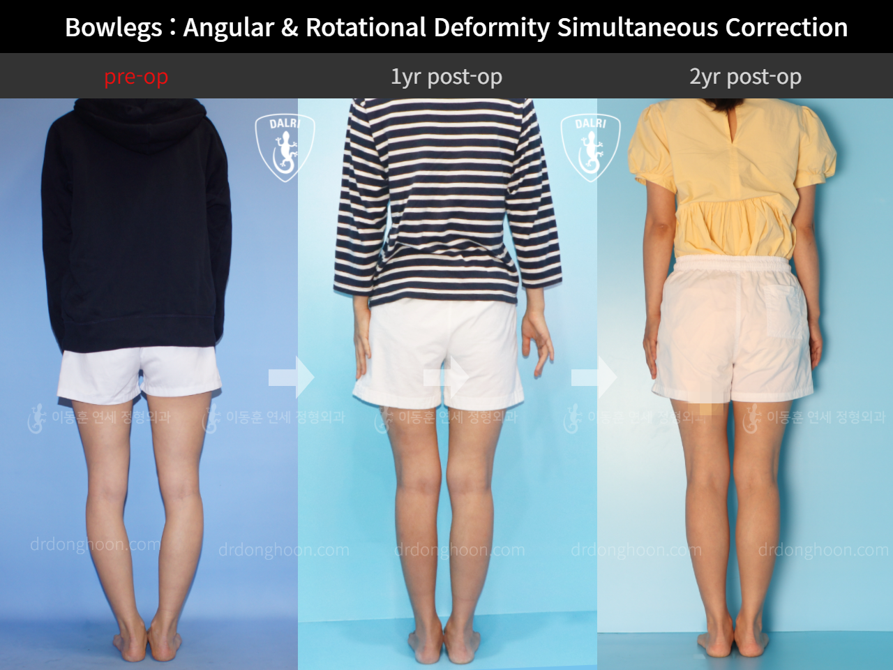 Before and after adult bowlegs, case 4311375, image 2, Dr. Donghoon institute (DALRI)