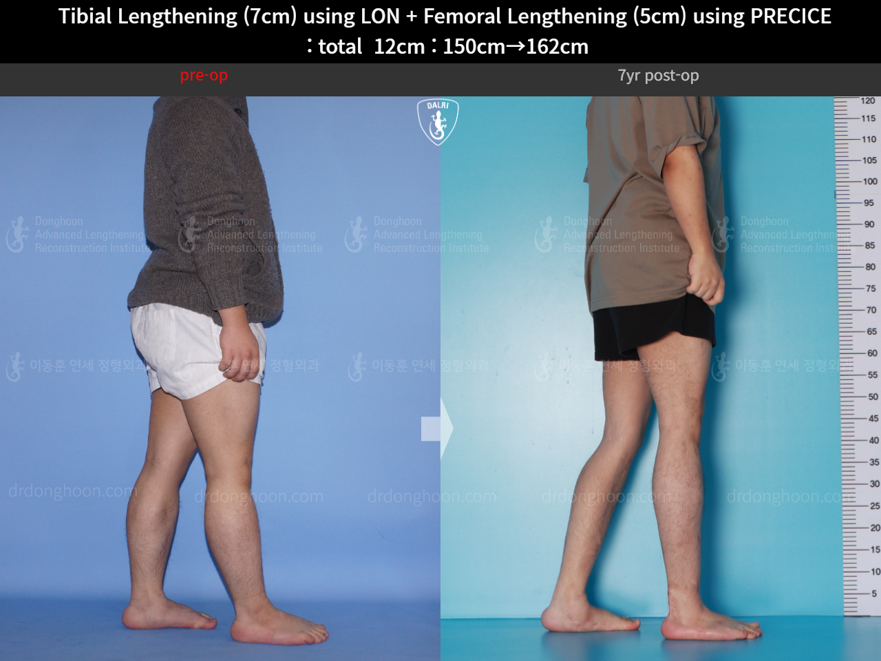 Before and after cll precice, case 16146445, image 7, Dr. Donghoon institute (DALRI)