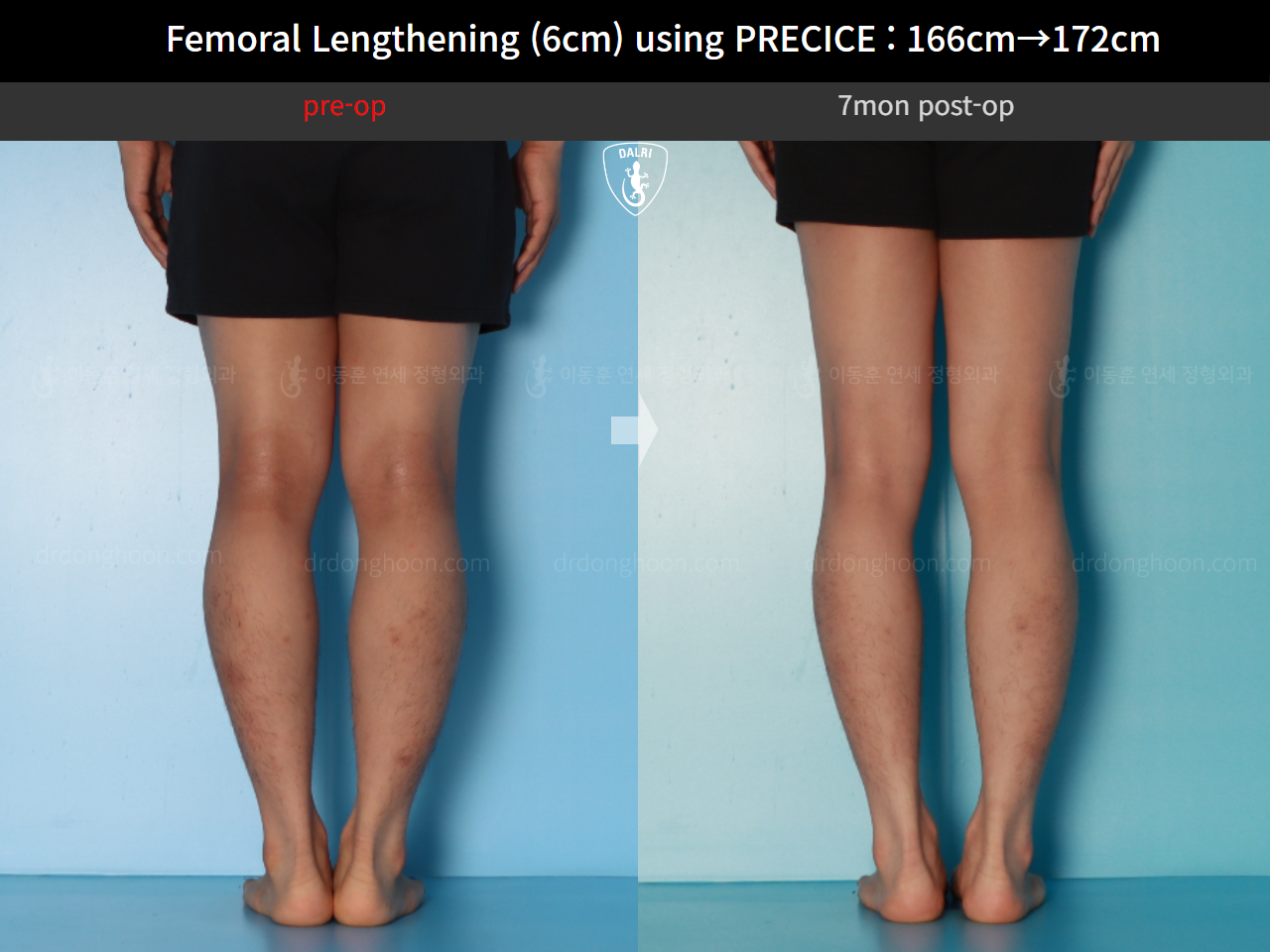 Before and after cll precice, case 17579263, image 6, Dr. Donghoon institute (DALRI)