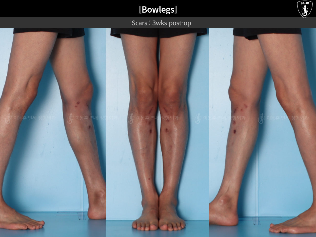 Before and after adult bowlegs, case 32564251, image 13, Dr. Donghoon institute (DALRI)