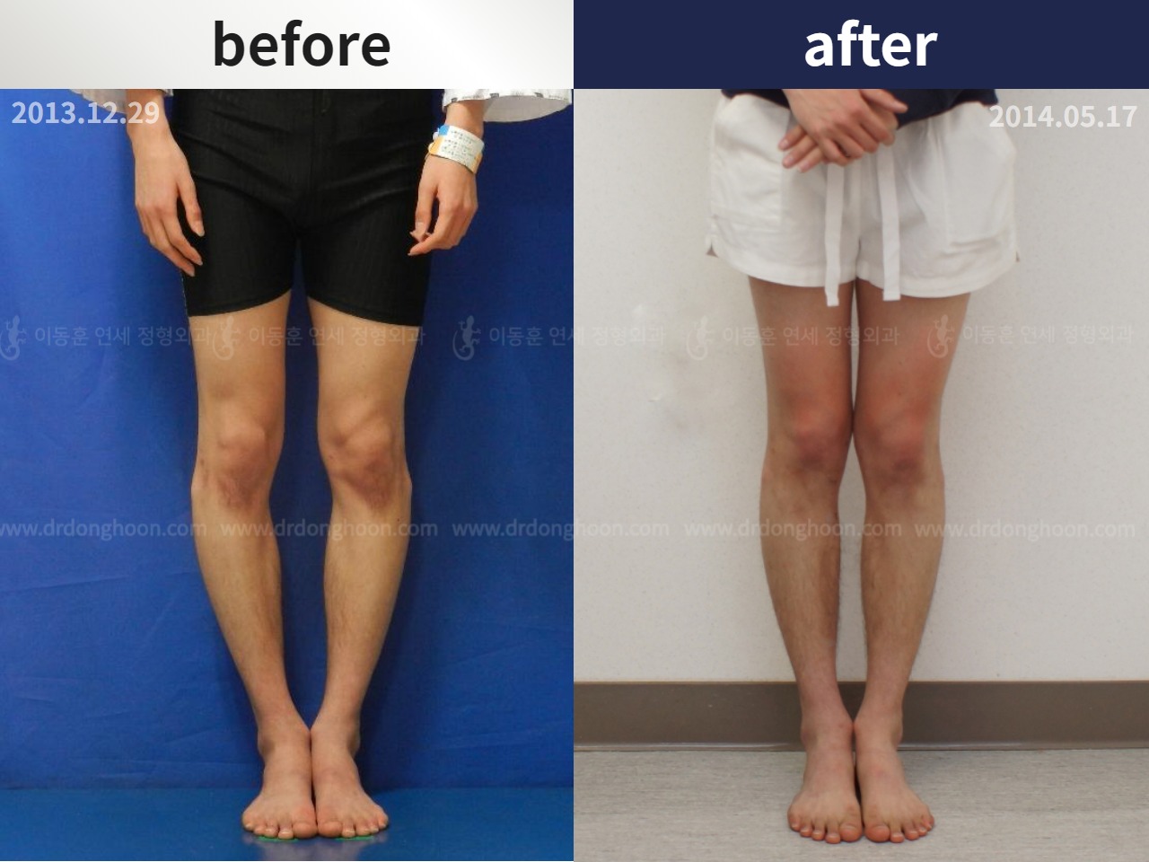 Before and after adult bowlegs, case 4311038, image 1, Dr. Donghoon institute (DALRI)