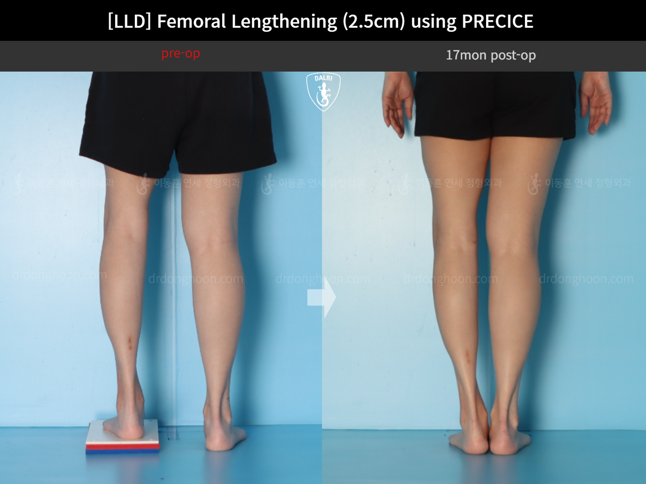 Before and after adult lld, case 18263358, image 6, Dr. Donghoon institute (DALRI)