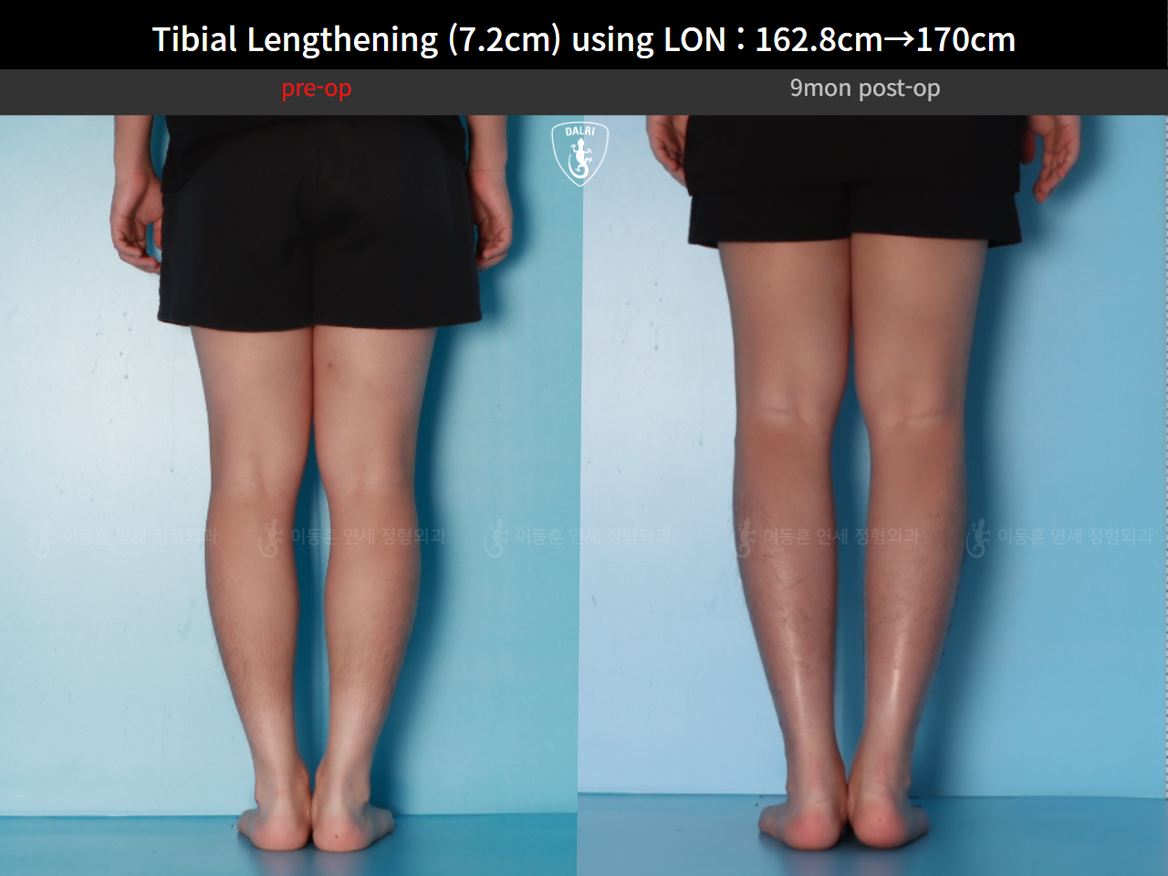 Before and after cll lon, case 124820559, image 7, Dr. Donghoon institute (DALRI)