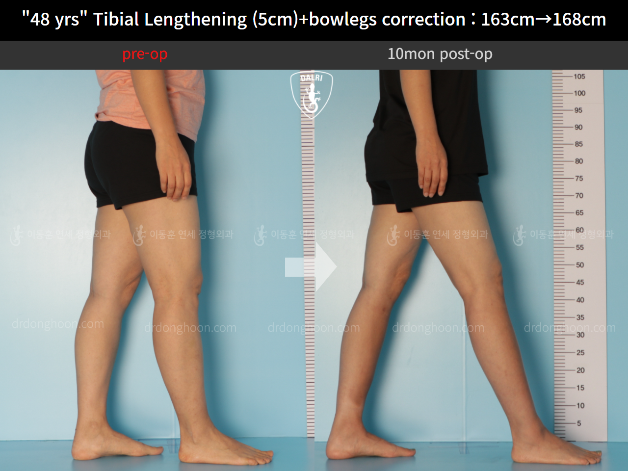 Before and after cll precice, case 10474341, image 7, Dr. Donghoon institute (DALRI)
