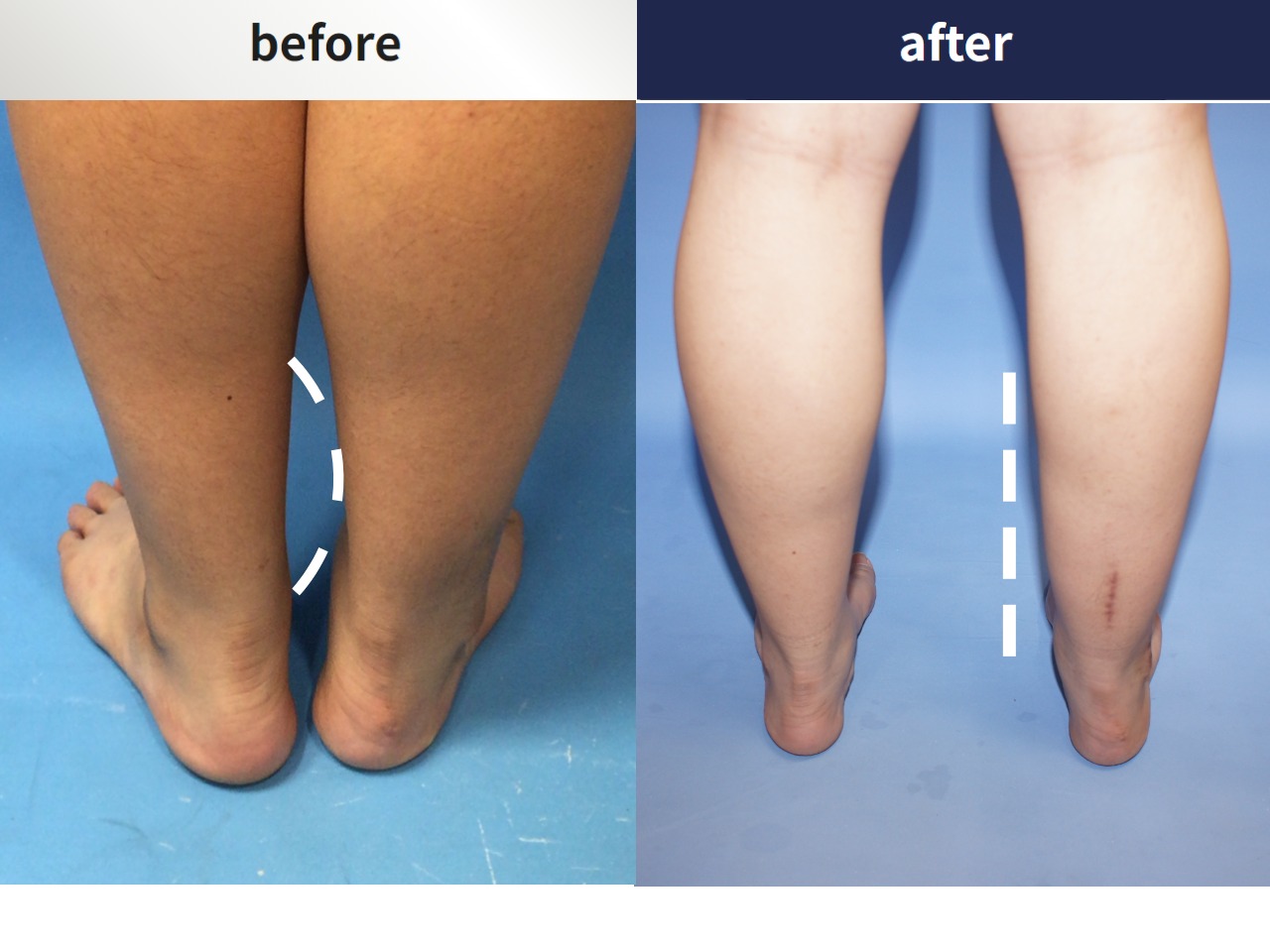 Before and after foot & ankle deformity, case 4247987, image 3, Dr. Donghoon institute (DALRI)