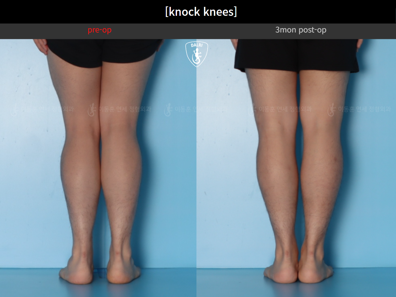 Before and after adult knock knees, case 124642361, image 8, Dr. Donghoon institute (DALRI)