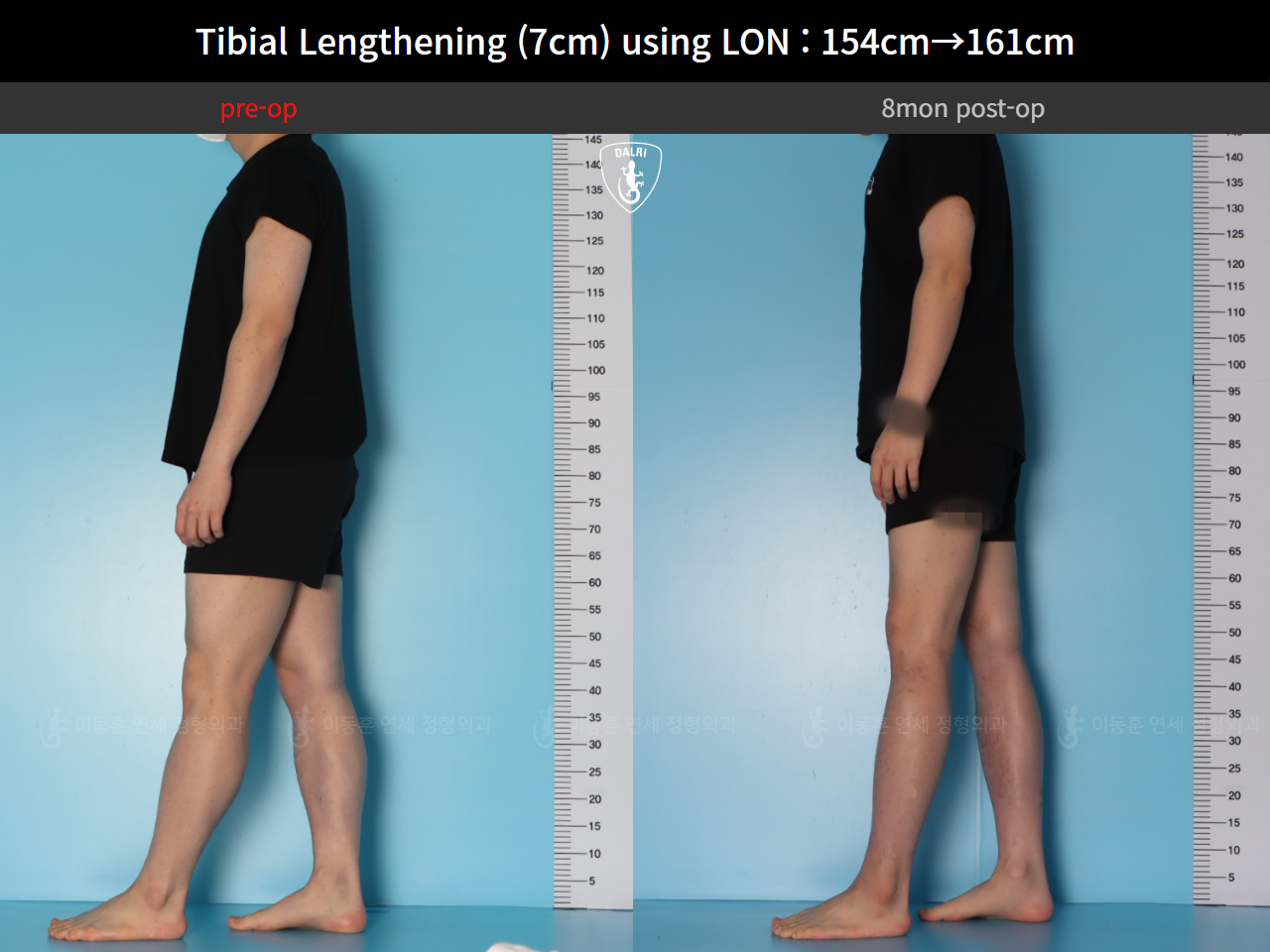 Before and after cll lon, case 127519935, image 5, Dr. Donghoon institute (DALRI)