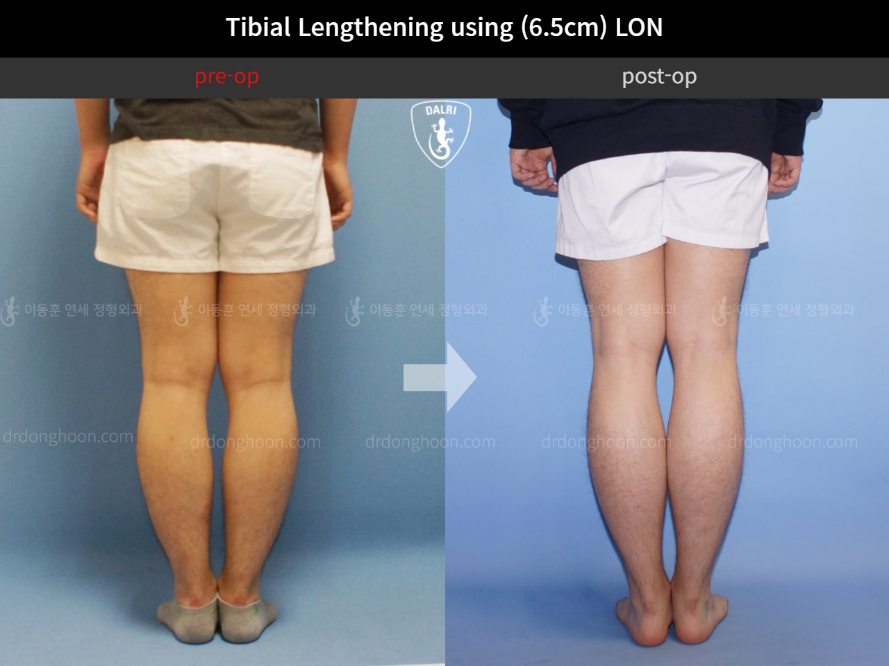 Before and after cll lon, case 4323455, image 4, Dr. Donghoon institute (DALRI)