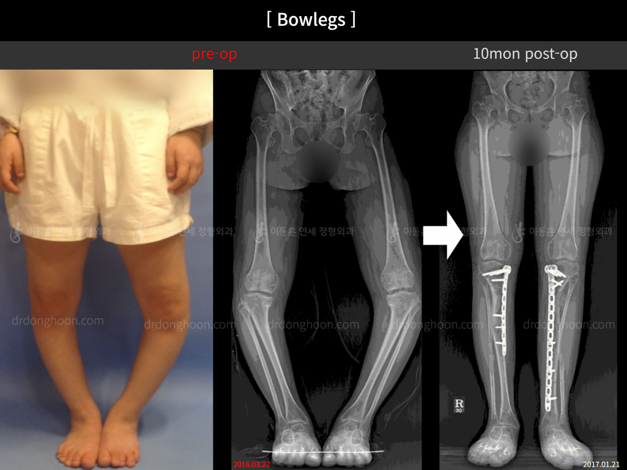 Before and after paediatric & adolescent bowlegs, case 12362822, image 1, Dr. Donghoon institute (DALRI)