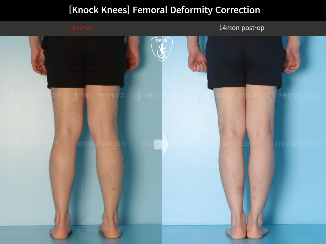 Before and after adult knock knees, case 15816319, image 8, Dr. Donghoon institute (DALRI)