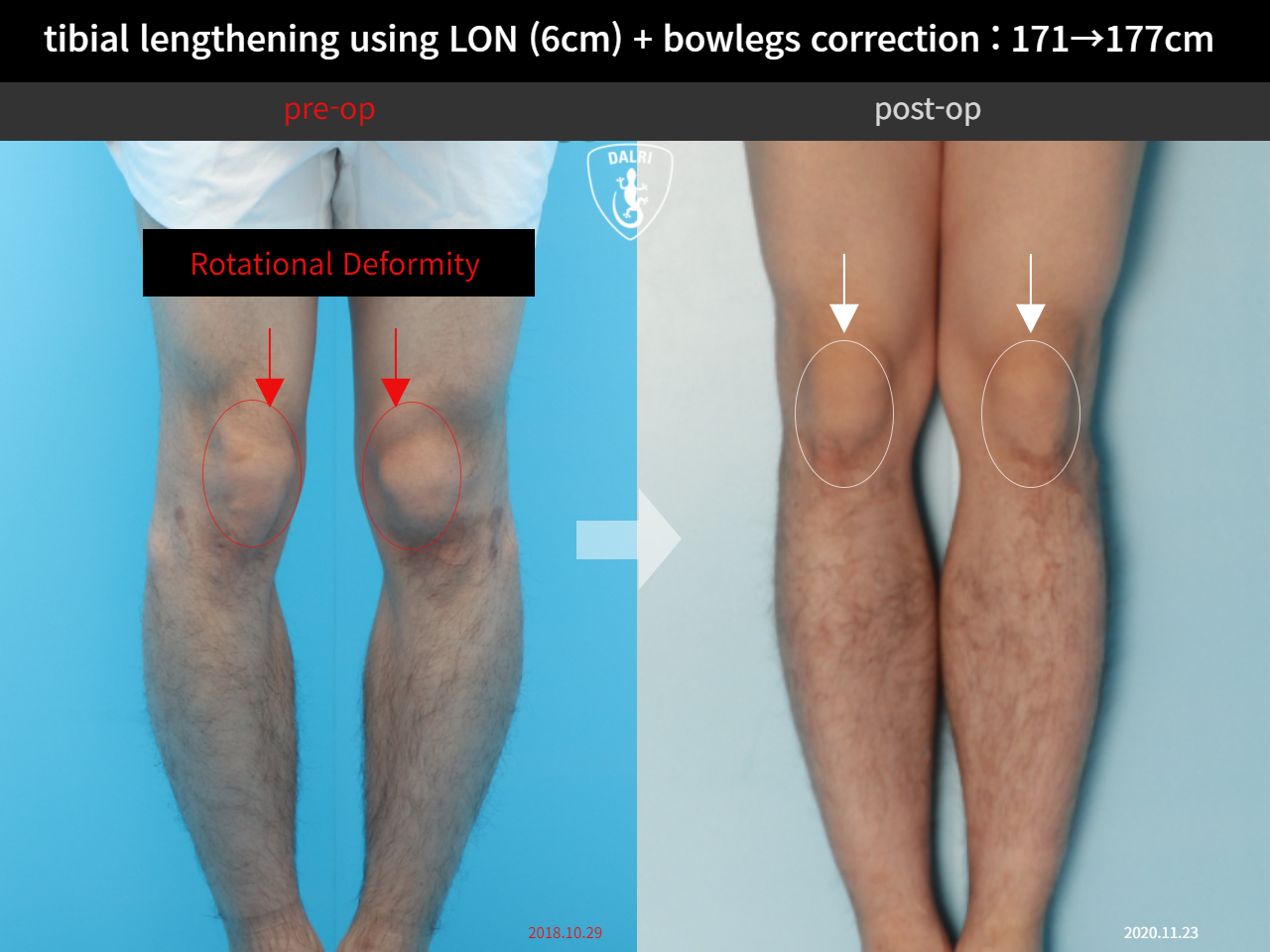 Before and after cll + deformity correction, case 11798378, image 2, Dr. Donghoon institute (DALRI)