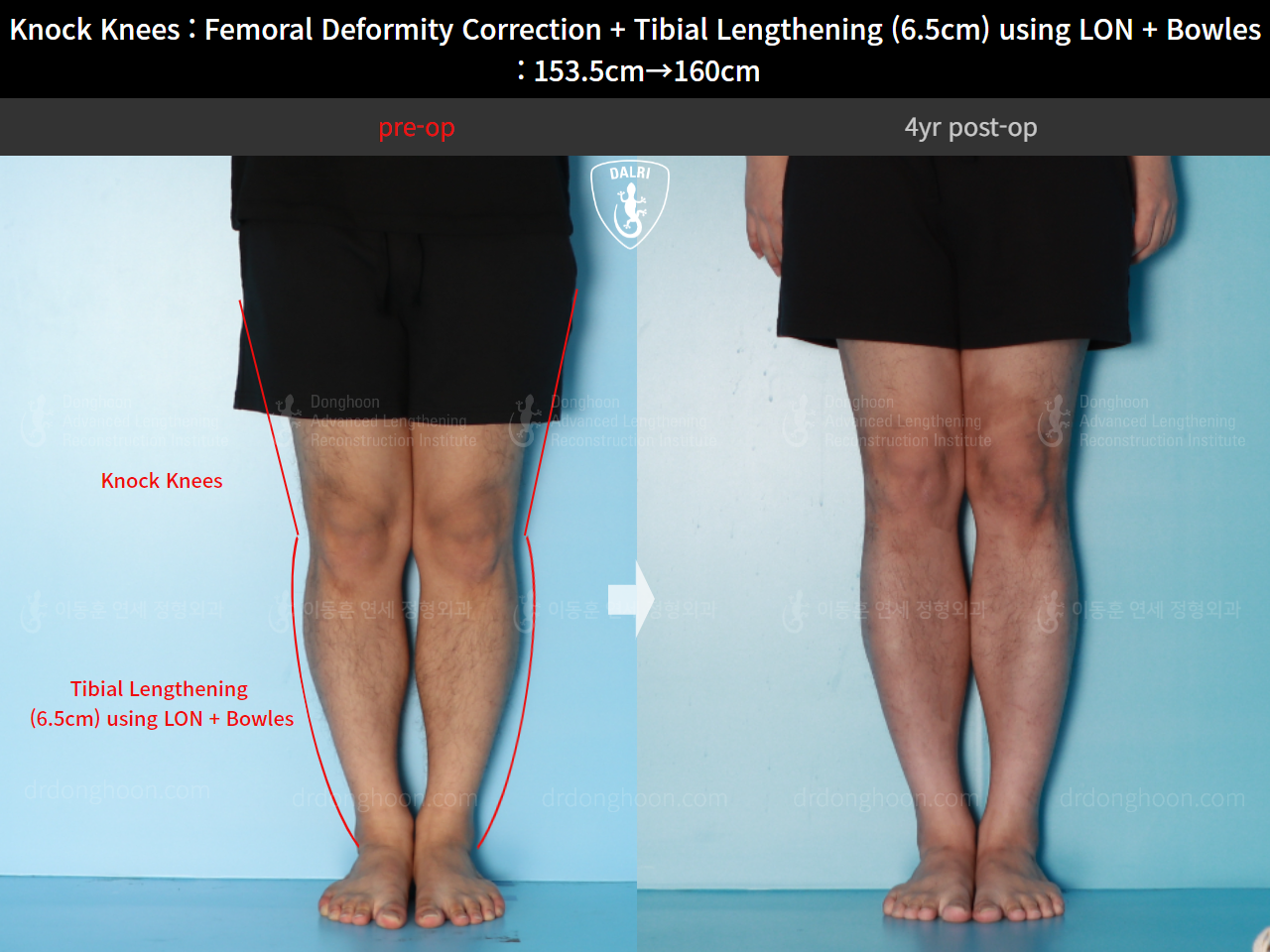 Knock Knees : Femoral Deformity Correction + Tibial Lengthening (6.5cm ...