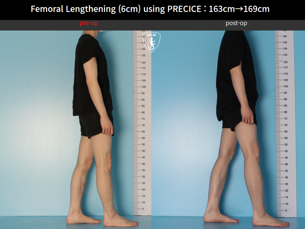 Before and after cll precice, case 33545760, image 3, Dr. Donghoon institute (DALRI)