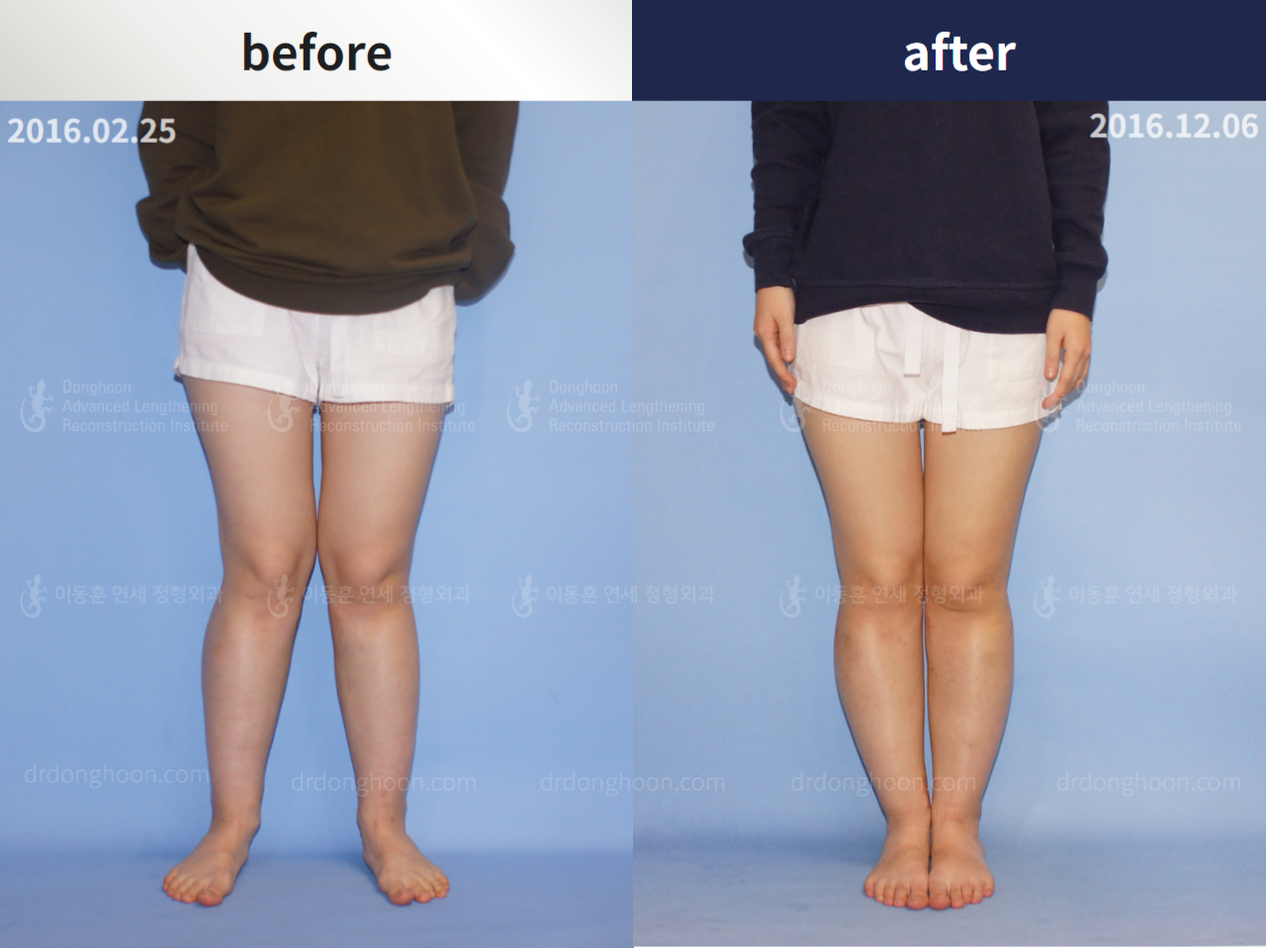Before and after congenital condition, case 4304666, image 1, Dr. Donghoon institute (DALRI)