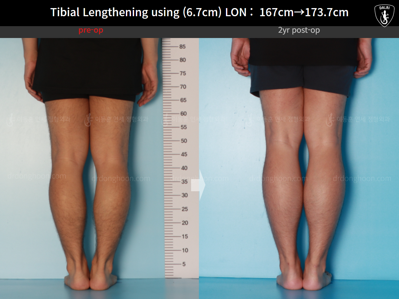 Before and after cll lon, case 16165376, image 8, Dr. Donghoon institute (DALRI)